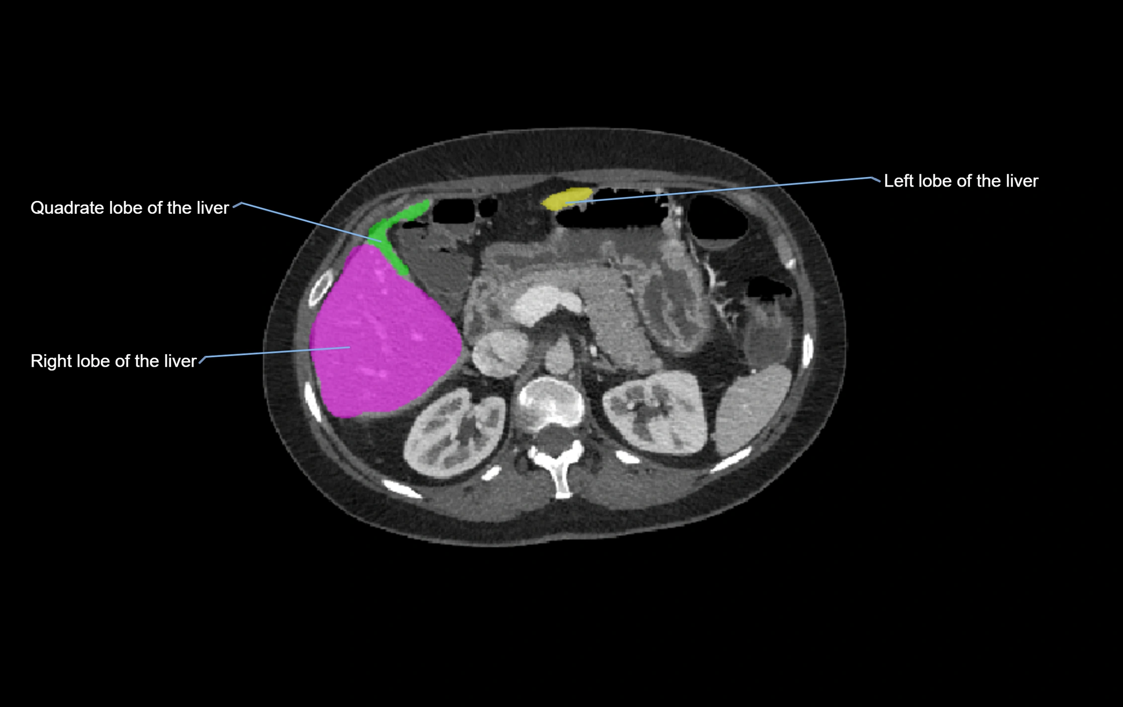 CT lliver lobes axial cross sectional anatomy labelled image -00036.webp